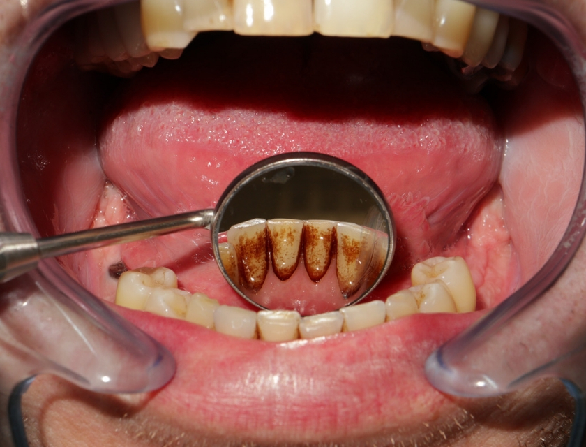 dentálna hygiena